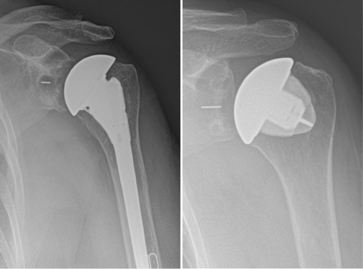 Total Shoulder Replacement Surgery